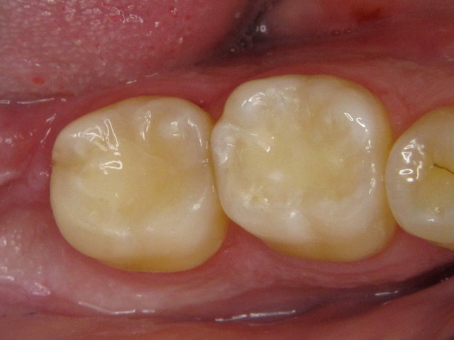 Composit-Füllungen by CLINICDENT ✓