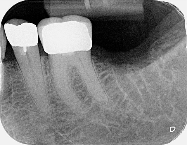 Fehlender Zahn im Röntgenbild ...