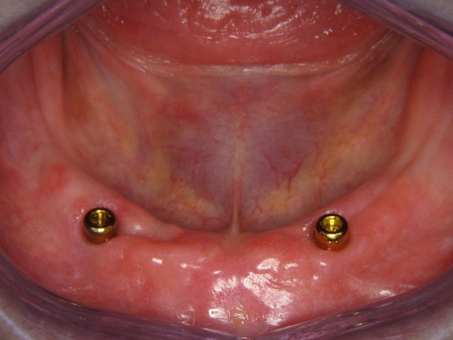 Zwei Implantate zur Verankerung im Mund