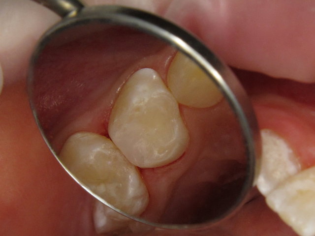 Composit-Füllung by CLINICDENT ✓