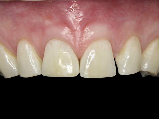 Bleaching by CLINICDENT ✓