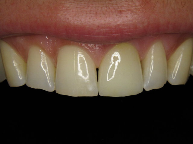 Vollkeramik-Krone by CLINICDENT ✓