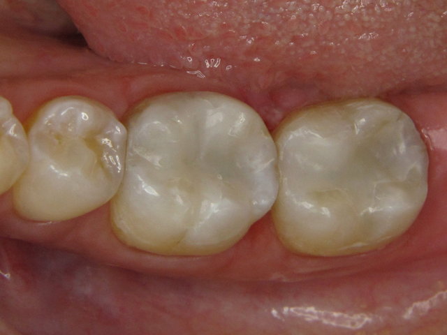Composit-Füllungen by CLINICDENT ✓