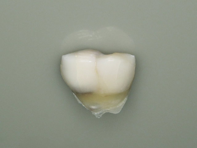 Abfrakturierte natürliche Zahnwand & Putzdefekt ...