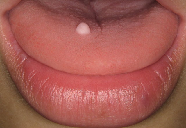 Gewebswucherung auf der Zunge ...