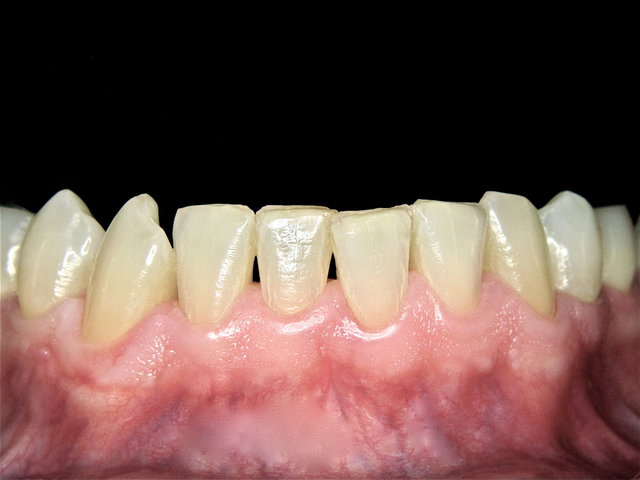 Gesunde Gingiva nach Dentalhygiene by CLINICDENT ✓