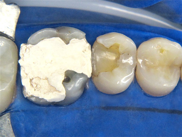 Provisorium und Composit-Füllung ohne Verbundtechnik ...