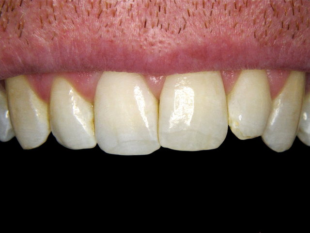 Bleaching by CLINICDENT ✓