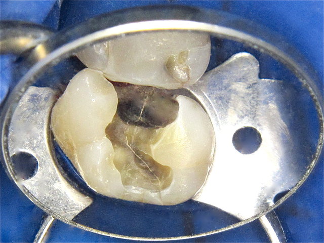 Interner zentraler Riss nach Amalgam-Entfernung ...