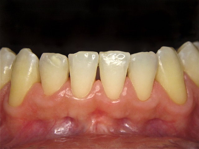 Gesunde Gingiva nach Dentalhygiene by CLINICDENT ✓