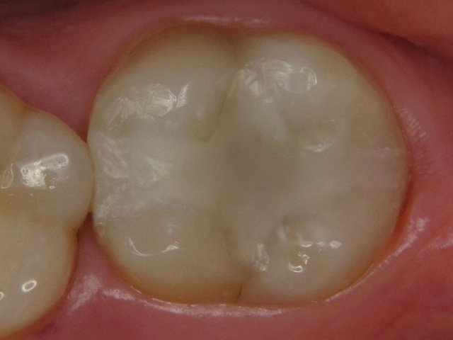 Composit-Füllung by CLINICDENT ✓