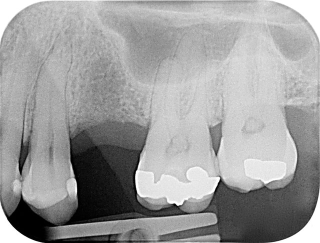 Fehlender Zahn im Röntgenbild ...