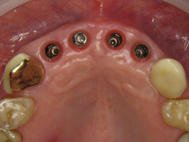 Vier Implantate