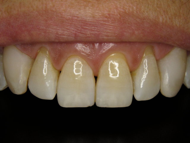 Composit-Füllungen und Bleaching by CLINICDENT ✓