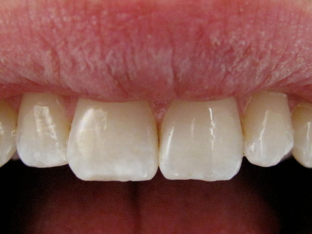 Composit-Füllungen by CLINICDENT ✓