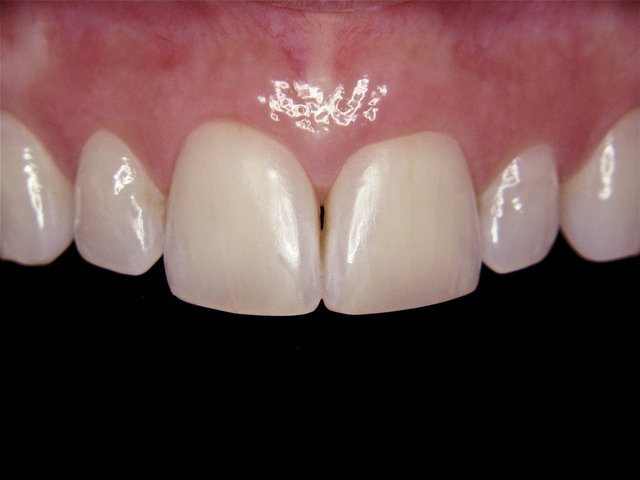 Composit-Füllung by CLINICDENT ✓