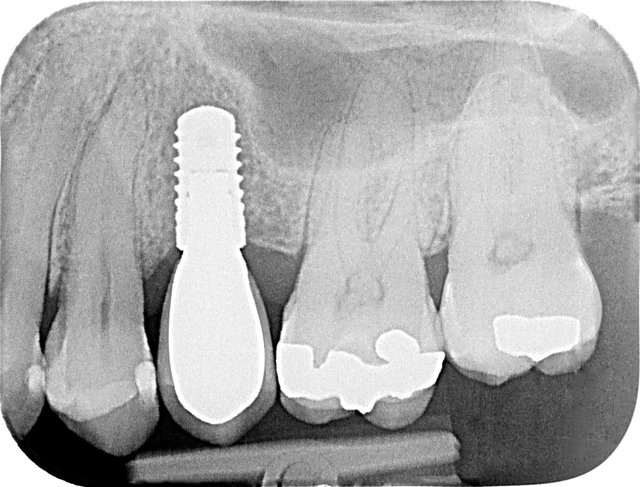 Implantat by CLINICDENT ✓