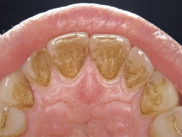 Zahnsteinbildung erfolgt schleichend & langsam ...
