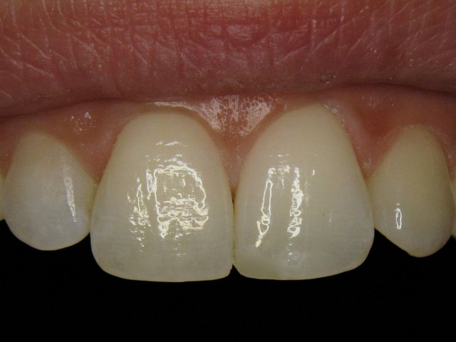 Composit-Füllung by CLINICDENT ✓