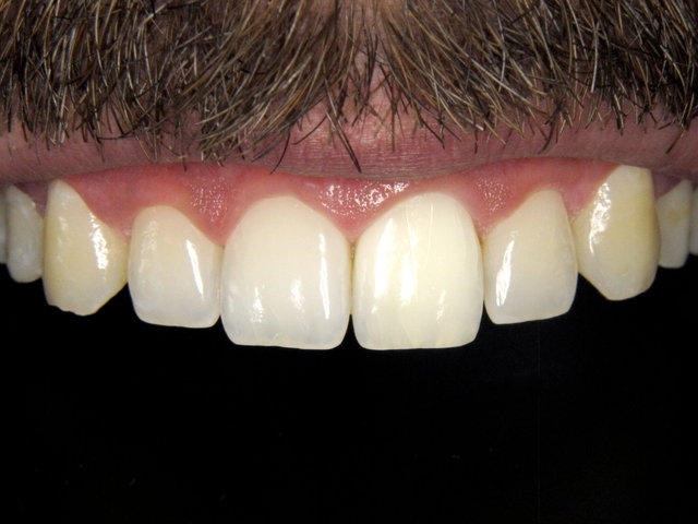 Bleaching by CLINICDENT ✓