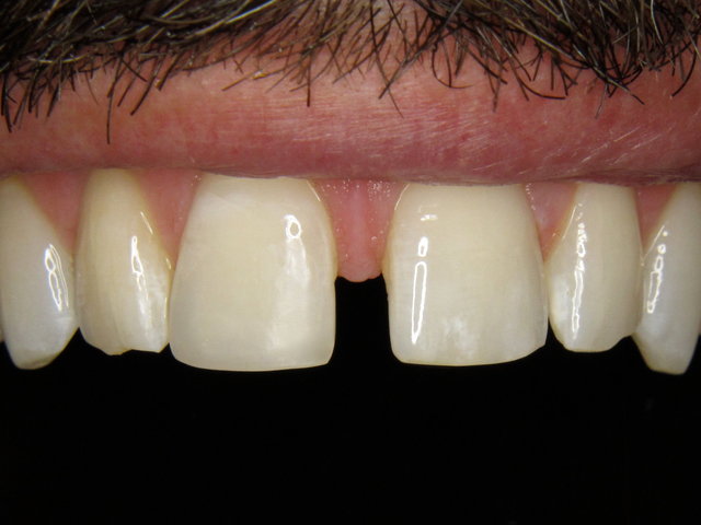 Composit-Füllung by CLINICDENT ✓