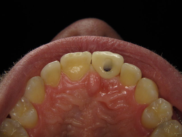 Eingeschraubte Implantatkrone ✓