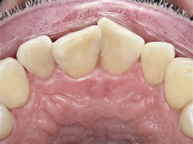 Dentalhygiene und Composit-Füllungen by CLINICDENT ✓