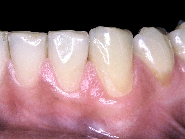 Laserbehandlung by CLINICDENT ✓