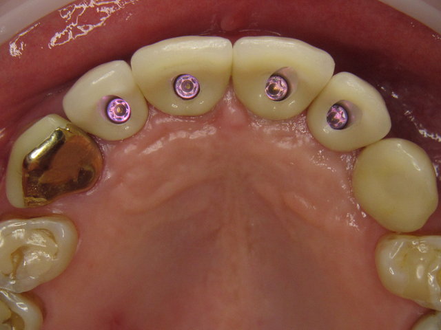 Eingeschraubte Implantat-Kronen ✓