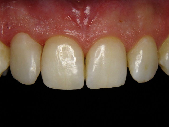 Composit-Füllung by CLINICDENT ✓