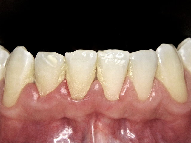 Gelblicher Zahnstein und entzündetes Zahnfleisch ...