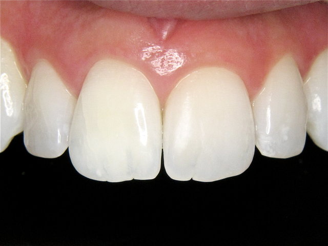 Bleaching by CLINICDENT ✓