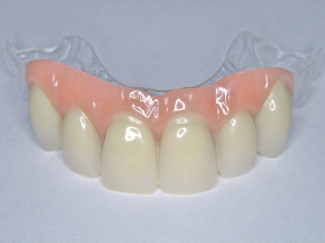 Frontzahn-Provisorium by CLINICDENT ✓
