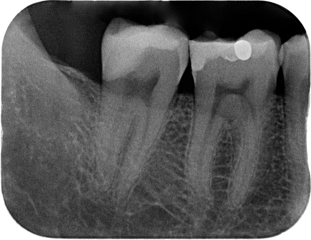 Composit-Füllung by CLINICDENT ✓