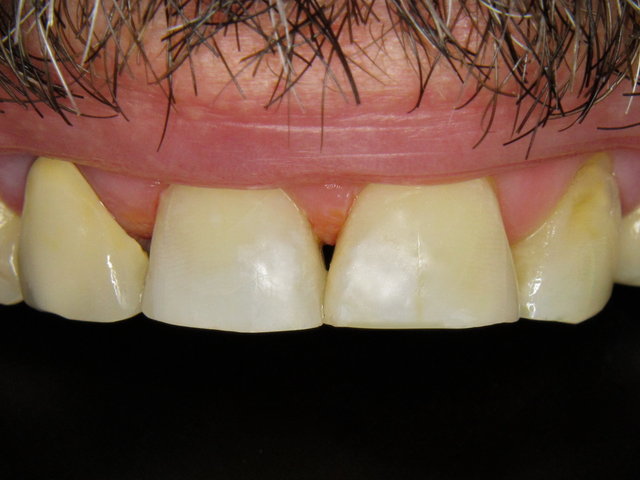 Composit-Füllungen by CLINICDENT ✓