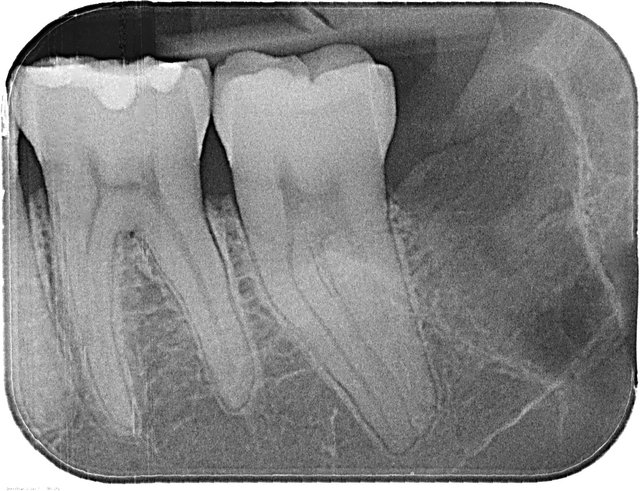 Komplikationslose Entfernung ✓