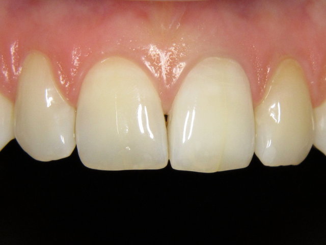 Bleaching by CLINICDENT ✓