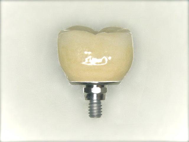 Implantatkrone by CLINICDENT ✓