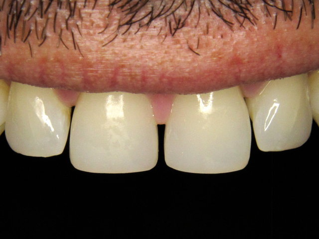 Composit-Füllungen by CLINICDENT ✓