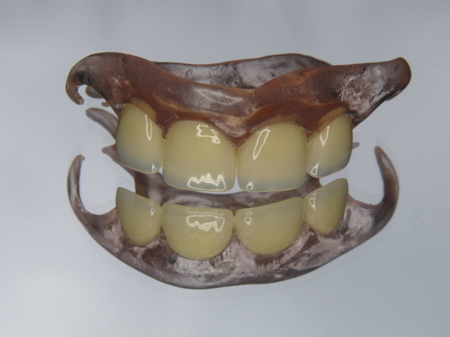 Nylon-Provisorium by CLINICDENT ✓