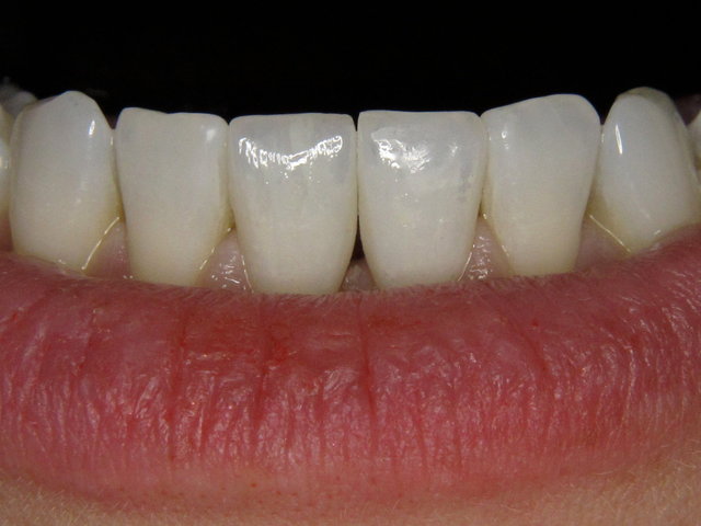 Vollkeramik-Kronen by CLINICDENT ✓