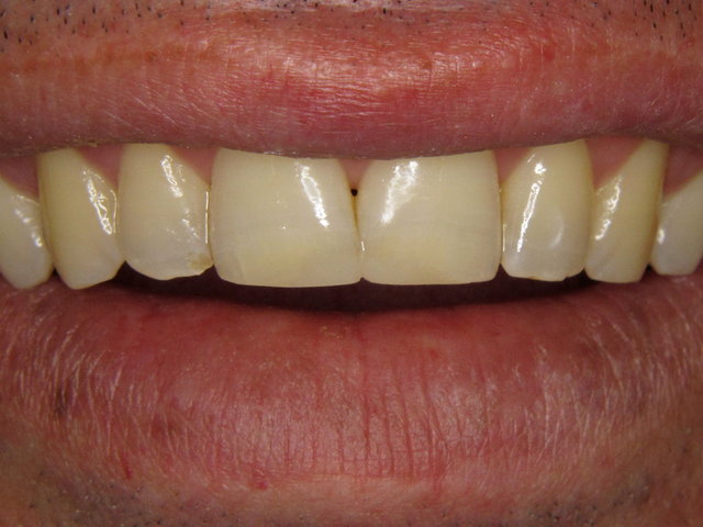 Composit-Füllungen by CLINICDENT ✓