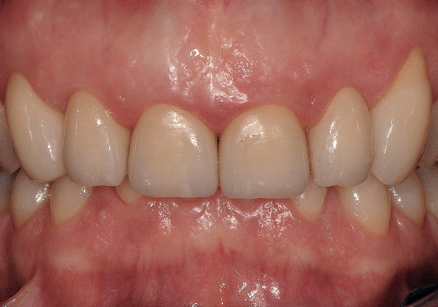 Veneers by CLINICDENT ✓