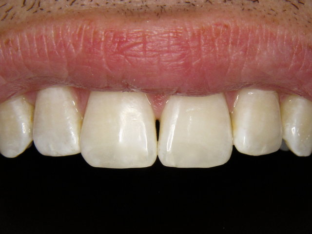 Composit-Füllungen by CLINICDENT ✓